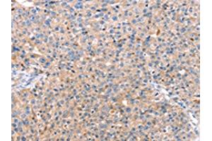 The image on the left is immunohistochemistry of paraffin-embedded Human breast cancer tissue using ABIN7128752(CAPN7 Antibody) at dilution 1/20, on the right is treated with fusion protein. (Calpain 7 anticorps)