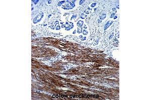 ACTA1 Antibody (ABIN1536597 and ABIN2843809) immunohistochemistry analysis in formalin fixed and paraffin embedded human colon carcinoma followed by peroxidase conjμgation of the secondary antibody and DAB staining. (Actin anticorps)