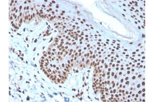 Formalin-fixed, paraffin-embedded human Basal Cell Carcinoma stained with Histone H1 Mouse Recombinant Monoclonal Antibody (rAE-4). (Recombinant Histone H1 anticorps)