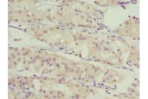 Immunohistochemistry of paraffin-embedded human gastric cancer using ABIN7166588 at dilution of 1:100