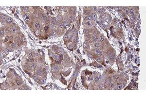 ABIN6276648 at 1/100 staining Human liver cancer tissue by IHC-P. (VAMP2 anticorps  (N-Term))