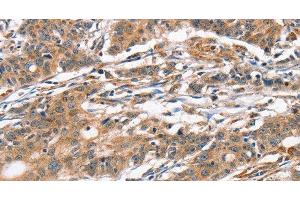 Immunohistochemistry of paraffin-embedded Human gasrtic cancer tissue using CAMK4 Polyclonal Antibody at dilution 1:40 (CAMK4 anticorps)