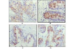Immunohistochemical analysis of paraffin-embedded human lung cancer (A), recturn(B), prostate (C), colon cancer (D) showing cytoplasmic localization using IGFBP2 antibody with DAB staining. (IGFBP2 anticorps  (AA 180-328))