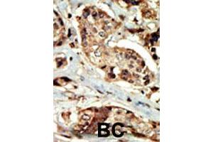 Formalin-fixed and paraffin-embedded human cancer tissue reacted with STK16 polyclonal antibody  , which was peroxidase-conjugated to the secondary antibody, followed by DAB staining. (STK16 anticorps  (AA 257-286))
