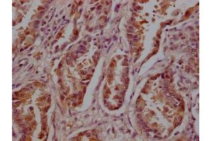 IHC image of ABIN7142109 diluted at 1:200 and staining in paraffin-embedded human lung cancer tissue performed on a Leica BondTM system.