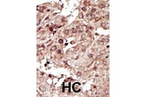 Formalin-fixed and paraffin-embedded human cancer tissue reacted with the primary antibody, which was peroxidase-conjugated to the secondary antibody, followed by AEC staining. (PHKG1 anticorps  (AA 302-332))