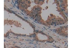 Detection of AATK in Human Prostate Tissue using Polyclonal Antibody to Apoptosis Associated Tyrosine Kinase (AATK)