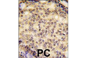 Formalin-fixed and paraffin-embedded human prostate carcinoma tissue reacted with SOX9 polyclonal antibody  , which was peroxidase-conjugated to the secondary antibody, followed by DAB staining. (SOX9 anticorps  (N-Term))