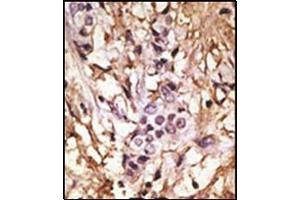 Formalin-Fixed, Paraffin-Embedded human cancer tissue reacted with LC3B Antibody (C-term) followed which was peroxidase-conjugated to the secondary antibody, followed by DAB staining.