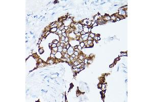 Immunohistochemistry of paraffin-embedded Human lung adenocarcinoma using Cytokeratin 19 (Cytokeratin 19 (KRT19)) Rabbit pAb (ABIN3020778, ABIN3020779, ABIN3020780 and ABIN6213719) at dilution of 1:150 (40x lens).