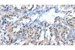 Immunohistochemistry of paraffin-embedded Human thyroid cancer tissue using PAK6 Polyclonal Antibody at dilution 1:40 (PAK6 anticorps)