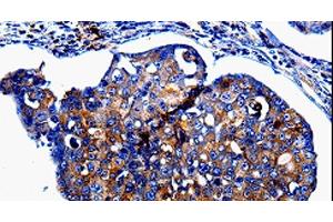 Immunohistochemistry of paraffin-embedded Human breast cancer tissue using IL10RB Polyclonal Antibody at dilution 1:60 (IL10RB anticorps)