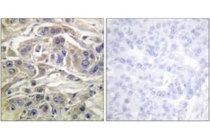 Immunohistochemistry analysis of paraffin-embedded human breast carcinoma, using RapGEF1 (Ab-504) Antibody. (GRF2 anticorps  (AA 470-519))