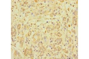 Immunohistochemistry of paraffin-embedded human pancreatic cancer using ABIN7176219 at dilution of 1:100 (ZNF287 anticorps  (AA 130-364))