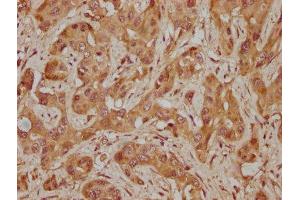 IHC image of ABIN7155266 diluted at 1:300 and staining in paraffin-embedded human melanoma cancer performed on a Leica BondTM system. (KAT2A anticorps  (AA 302-537))