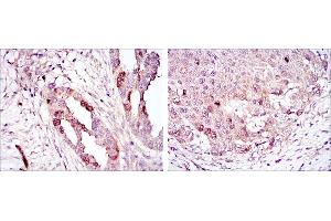 Immunohistochemical analysis of paraffin-embedded ovarian cancer (left) and lung cancer (right) using AURKA mouse mAb with DAB staining.