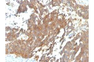 Immunohistochemical staining (Formalin-fixed paraffin-embedded sections) of human ovarian carcinoma with GNRHR/LHCGR monoclonal antibody, clone GNRHR/768 . (GNRHR anticorps)