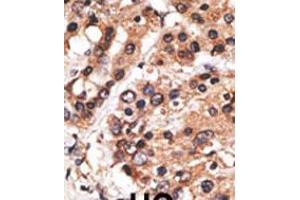 Formalin-fixed and paraffin-embedded human cancer tissue reacted with the primary antibody, which was peroxidase-conjugated to the secondary antibody, followed by AEC staining. (AF9 anticorps  (C-Term))