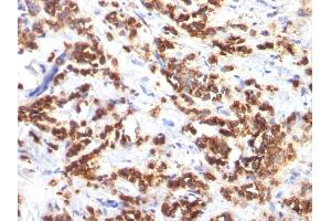 Formalin-fixed, paraffin-embedded human Breast Carcinoma stained with Milk Fat Globule Monoclonal Antibody (MFG-06) (MFGE8 anticorps)