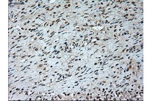 Immunohistochemical staining of paraffin-embedded Adenocarcinoma of breast tissue using anti-GAD1 mouse monoclonal antibody. (GAD anticorps)