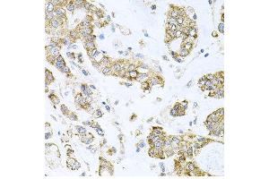 Immunohistochemistry of paraffin-embedded human gastric cancer using ALKBH8 antibody at dilution of 1:100 (x40 lens). (ALKBH8 anticorps)