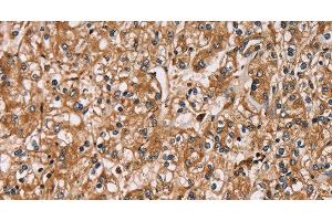 Immunohistochemistry of paraffin-embedded Human prostate cancer using HTR3C Polyclonal Antibody at dilution of 1:30 (HTR3C anticorps)