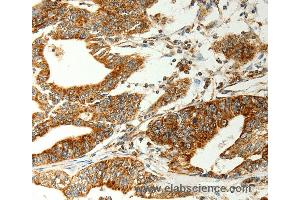Immunohistochemistry of Human gastic cancer using COX7B Polyclonal Antibody at dilution of 1:70