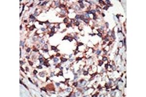 IHC analysis of FFPE human breast carcinoma tissue stained with the PKC beta antibody (PKC beta anticorps  (AA 303-334))