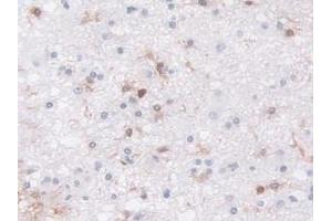 Detection of LCP1 in Human Glioma Tissue using Polyclonal Antibody to L-Plastin (LCP1) (LCP1 anticorps  (AA 5-233))