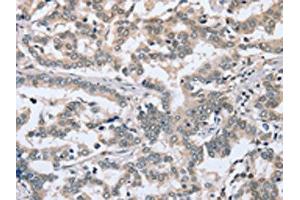 The image on the left is immunohistochemistry of paraffin-embedded Human liver cancer tissue using ABIN7192048(PTGER1 Antibody) at dilution 1/30, on the right is treated with synthetic peptide.
