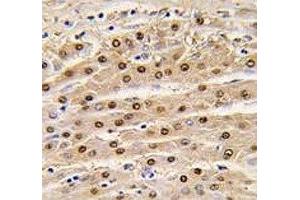 IHC analysis of FFPE human hepatocarcinoma tissue stained with anti-GAPDH antibody