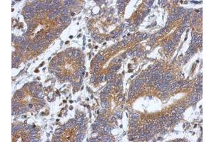 IHC-P Image Immunohistochemical analysis of paraffin-embedded human colon carcinoma, using ATXN10, antibody at 1:500 dilution.