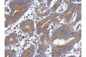 IHC-P Image Immunohistochemical analysis of paraffin-embedded human colon carcinoma, using ATXN10, antibody at 1:500 dilution. (Ataxin 10 anticorps)