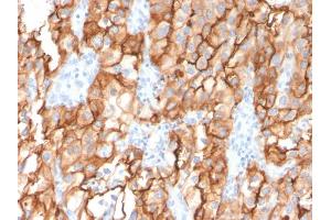 Formalin-fixed, paraffin-embedded human Renal Cell Carcinoma stained with CD10 Mouse Monoclonal Antibody (MME/2579).