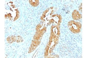 Formalin-fixed, paraffin-embedded human Rectum stained with Villin Mouse Monoclonal Antibody (VIL1/1325). (Villin 1 anticorps  (AA 179-311))
