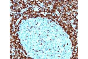 IHC testing of human non-Hodgkin's lymphoma stained with Bcl-2 antibody (124). (Bcl-2 anticorps  (AA 41-54))