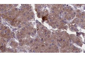 ABIN6272748 at 1/100 staining Human liver cancer tissue by IHC-P. (TAAR1 anticorps  (Internal Region))