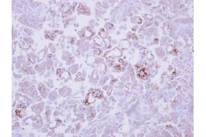 IHC-P Image Immunohistochemical analysis of paraffin-embedded human lung adenocarcinoma, using MMP13, antibody at 1:250 dilution. (MMP13 anticorps)