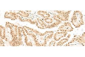 Immunohistochemistry of paraffin-embedded Human thyroid cancer tissue using BICRA Polyclonal Antibody at dilution of 1:40(x200) (BICRA anticorps)