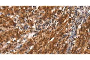 Immunohistochemistry of paraffin-embedded Human gasrtic cancer tissue using CYP2D6 Polyclonal Antibody at dilution 1:40 (CYP2D6 anticorps)