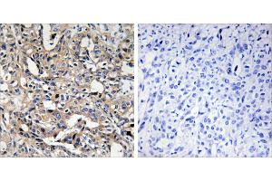 Peptide - +Immunohistochemistry analysis of paraffin-embedded human liver carcinoma tissue using BAX antibody. (BAX anticorps)