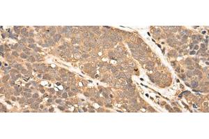 Immunohistochemistry of paraffin-embedded Human thyroid cancer tissue using ZPR1 Polyclonal Antibody at dilution of 1:40(x200) (ZNF259 anticorps)