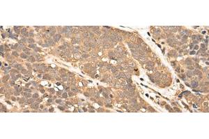 Immunohistochemistry of paraffin-embedded Human thyroid cancer tissue using ZPR1 Polyclonal Antibody at dilution of 1:40(x200) (ZNF259 anticorps)