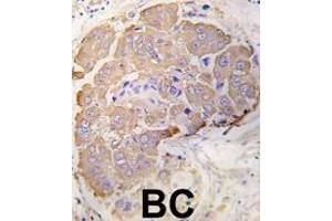 Formalin-fixed and paraffin-embedded human breast carcinoma tissue reacted with HSPB1 Antibody (S82) (ABIN391299 and ABIN2841335) , which was peroxidase-conjugated to the secondary antibody, followed by DAB staining. (HSP27 anticorps  (AA 60-89))