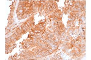 Formalin-fixed, paraffin-embedded human Colon Carcinoma stained with Beta-2-Microglobulin Mouse Recombinant Monoclonal Antibody (rB/961).