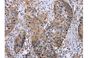 The image on the left is immunohistochemistry of paraffin-embedded Human esophagus cancer tissue using ABIN7130502(OPTN Antibody) at dilution 1/25, on the right is treated with fusion protein. (OPTN anticorps)