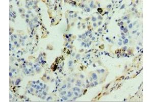 Immunohistochemistry of paraffin-embedded human lung cancer using ABIN7154097 at dilution of 1:100 (GSTA4 anticorps  (AA 93-222))