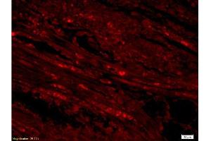 Formalin-fixed and paraffin embedded labeled with human gastric carcinoma Rabbit Anti-AIF Polyclonal Antibody, Unconjugated  1:300 followed by conjugation to the secondary antibody Goat Anti-Rabbit IgG, PE