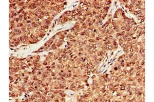 Immunohistochemistry of paraffin-embedded human ovarian cancer using ABIN7150624 at dilution of 1:100 (Mre11 anticorps  (AA 1-205))