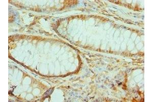 Immunohistochemistry of paraffin-embedded human colon cancer using ABIN7172290 at dilution of 1:100